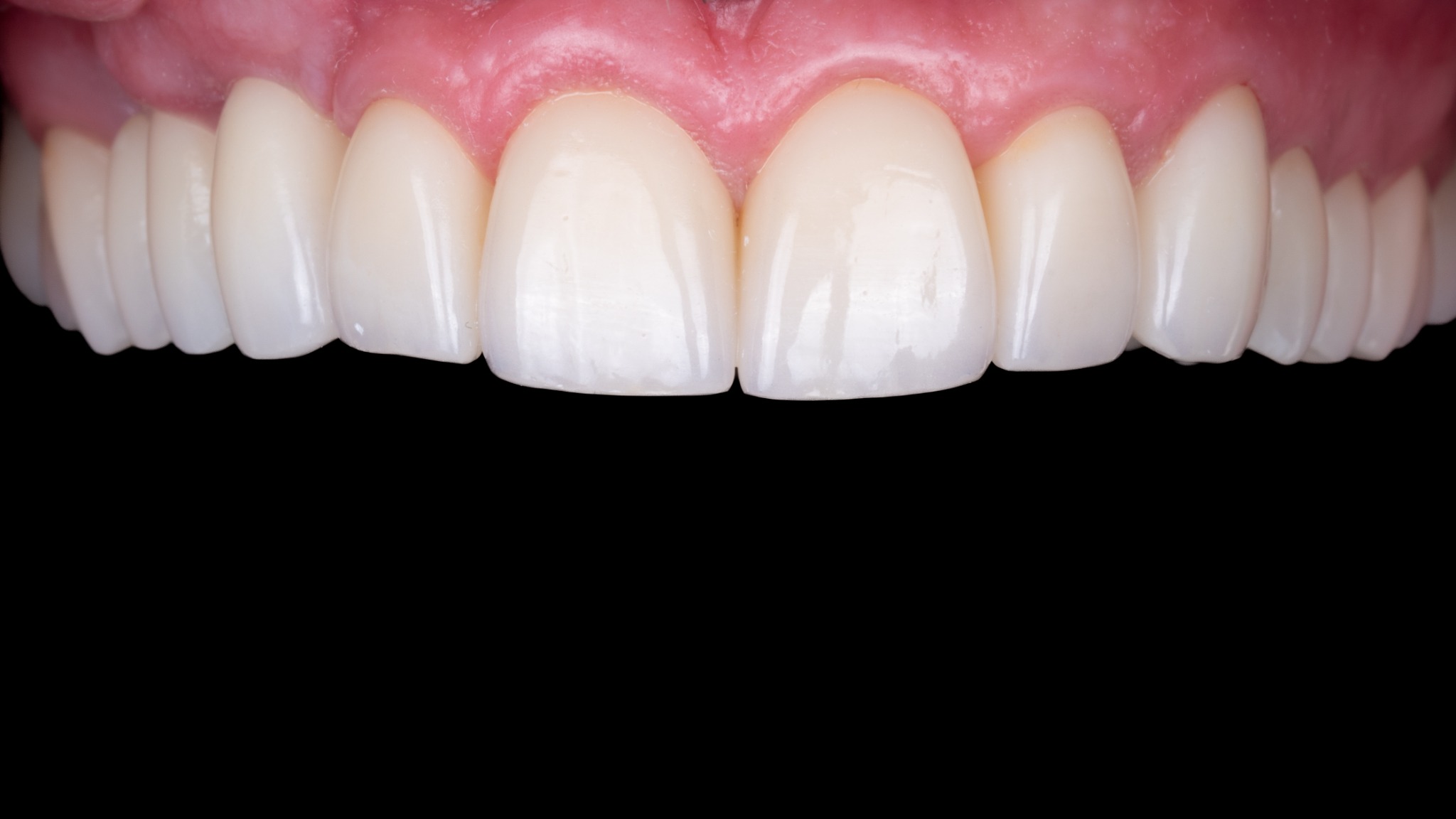 Po léčbě – bělení a rekonstrukce skloviny (případ 1)