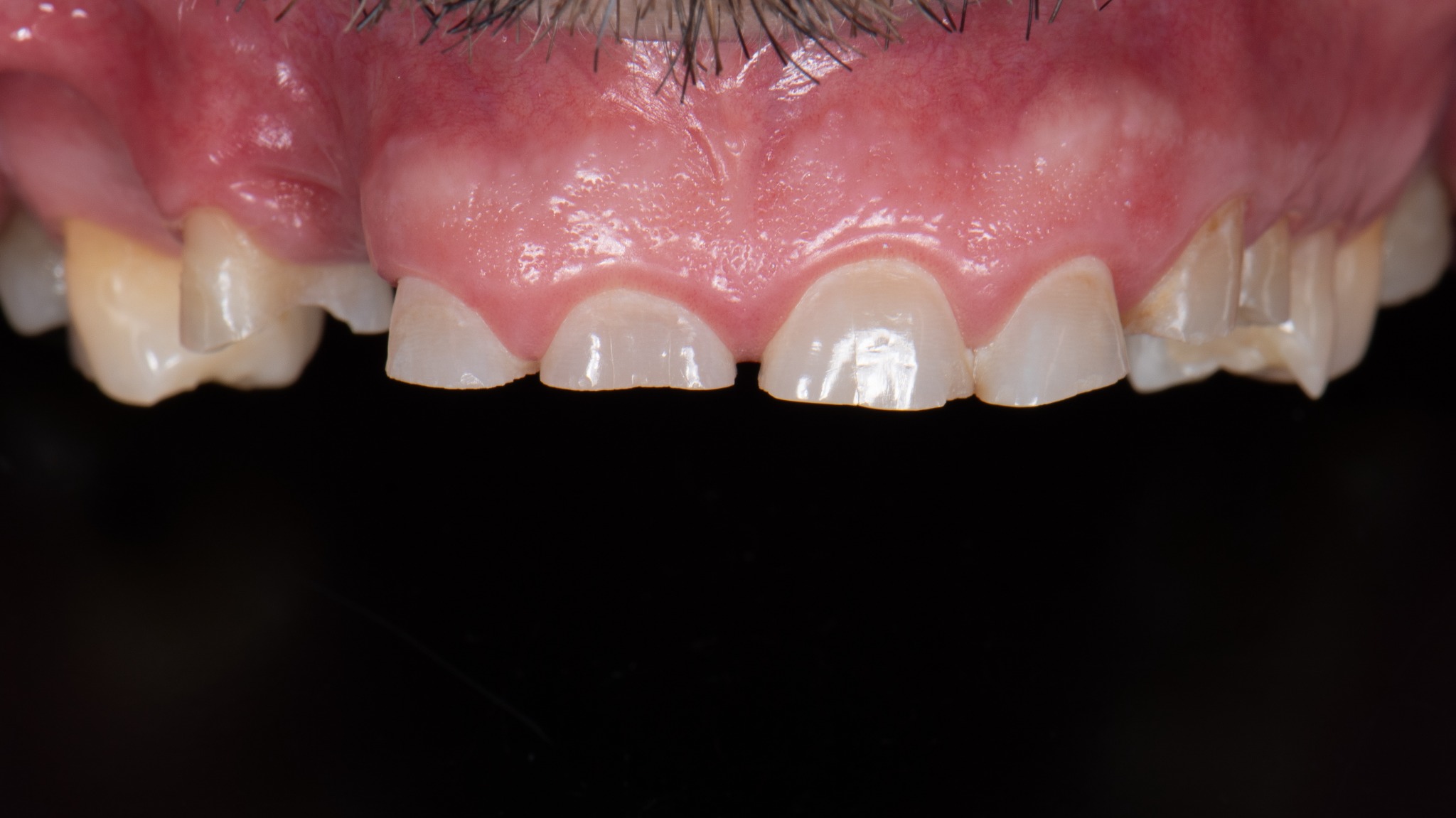 Před léčbou – bělení a rekonstrukce skloviny (případ 1)