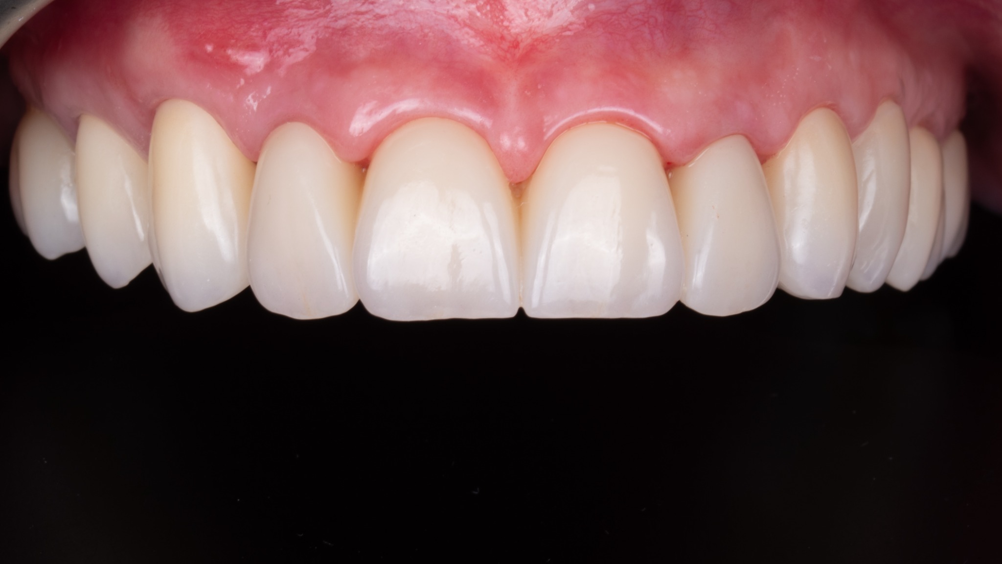 Po léčbě – estetická rekonstrukce fazetami (případ 2)