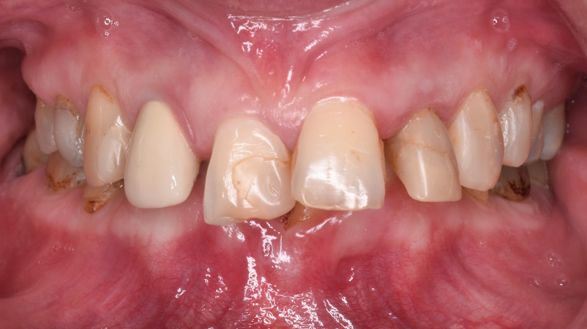 Před léčbou – estetická rekonstrukce fazetami (případ 2)