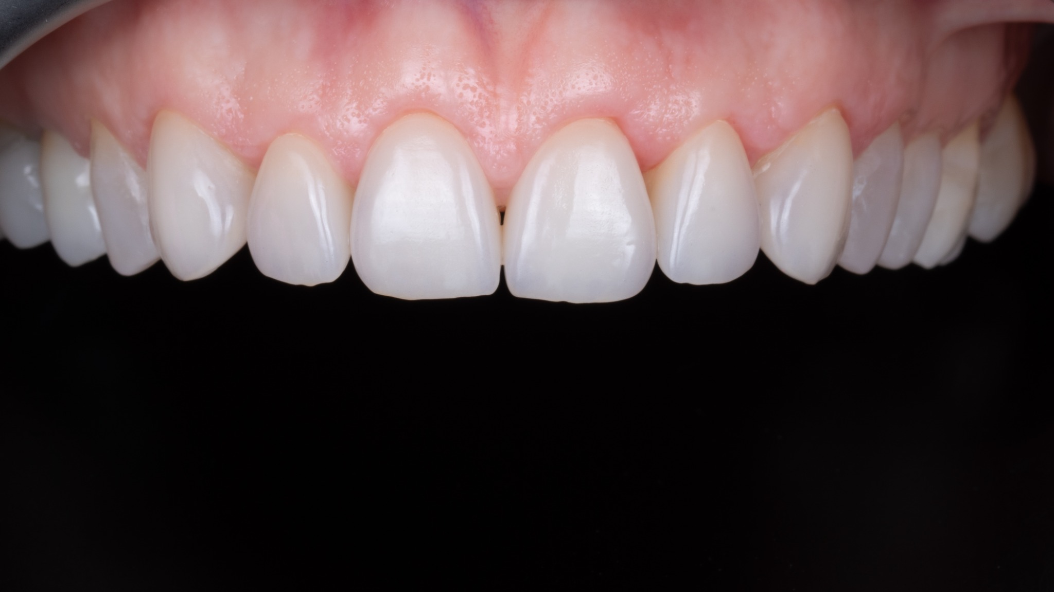 Po léčbě – protetika a estetické doplnění (případ 3)