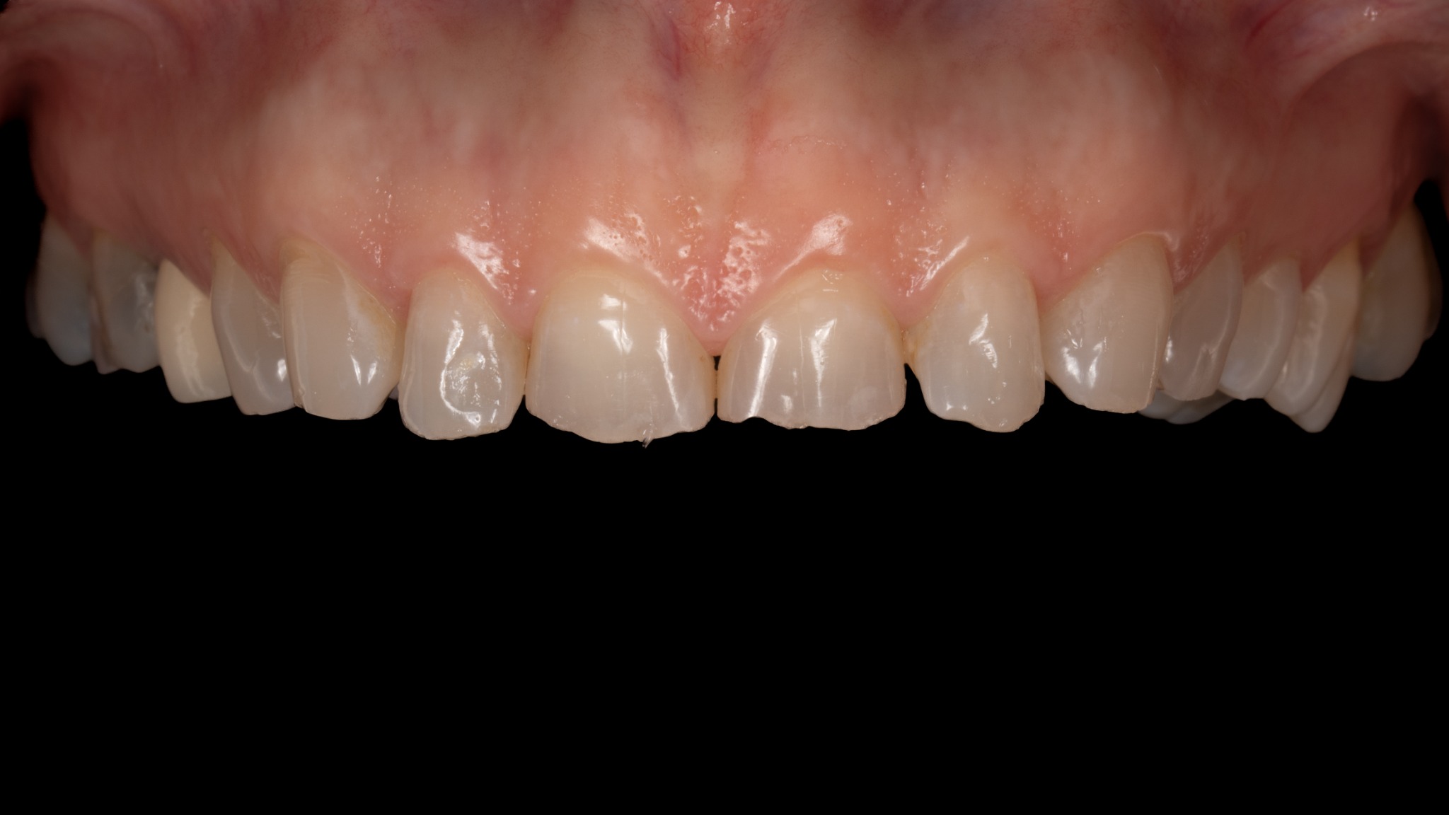 Před léčbou – protetika a estetické doplnění (případ 3)