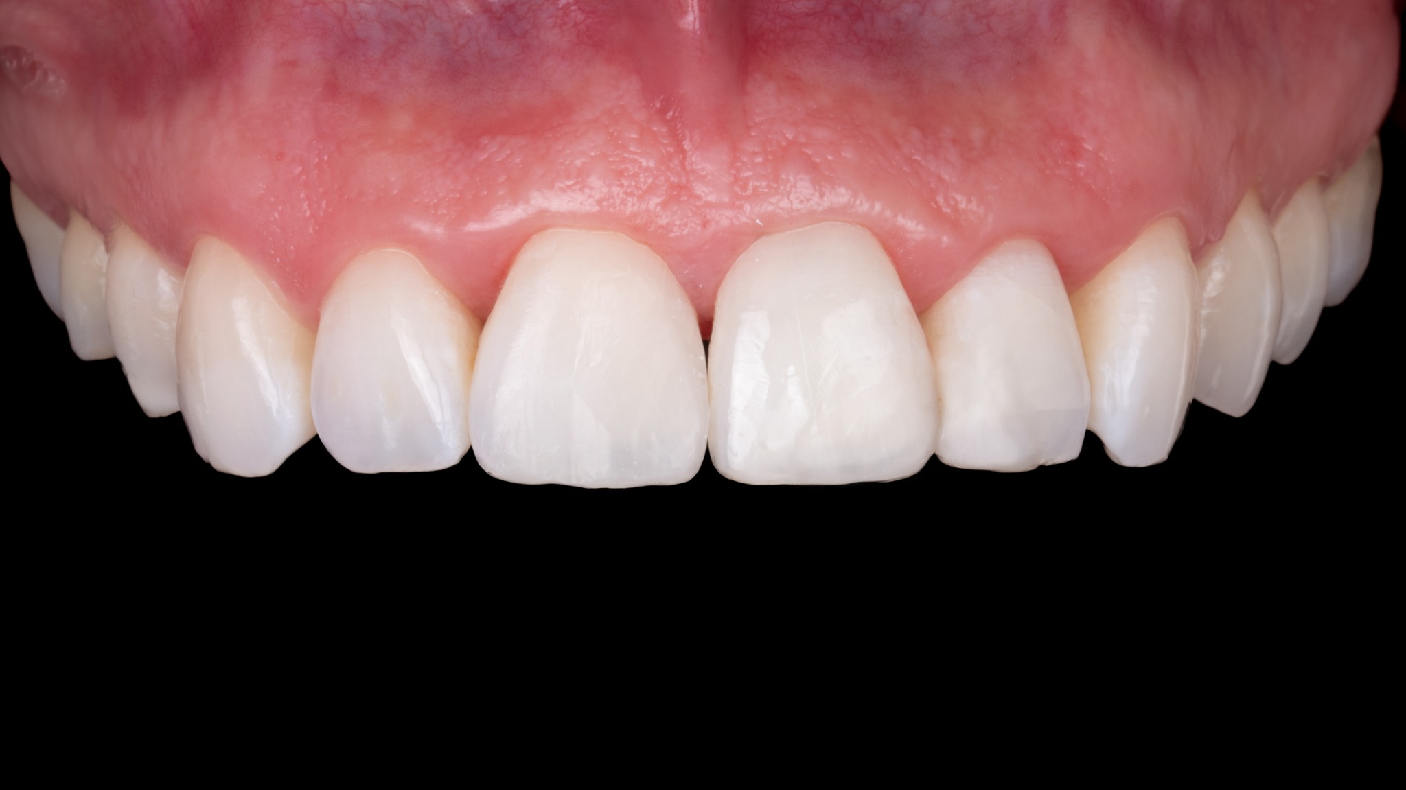 Po léčbě – implantologie a korunka (případ 4)