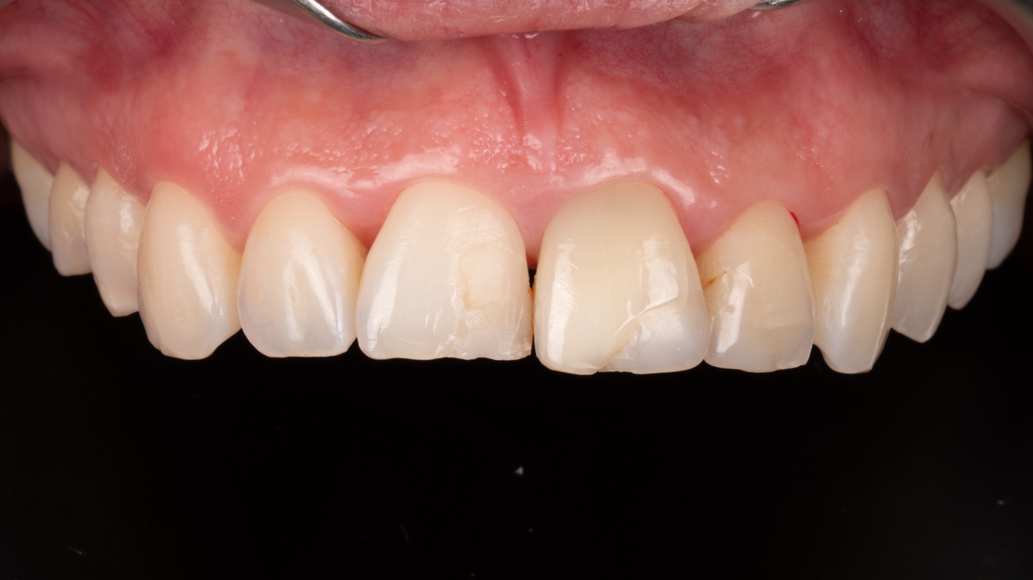 Před léčbou – implantologie a korunka (případ 4)